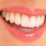 Blanquear-los-dientes