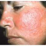 Dermatitis solar