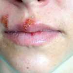 Herpes-labial