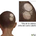 Infecciones cutáneas