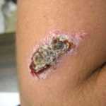 Leishmaniasis