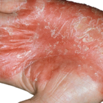 Psoriasis