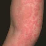 Urticaria