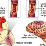 Accidente Cerebrovascular