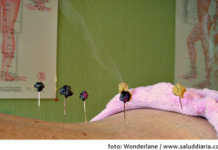 La acupuntura ¿Provoca dolor?