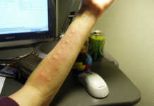 Cómo prevenir las alergias en los niños