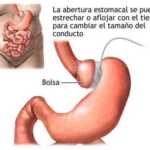 Bypass Gástrico