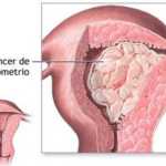 Cáncer de Endometrio