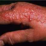 dermatitis de contacto