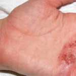 Dermatitis de Contacto