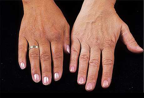 De donde viene la enfermedad de addison