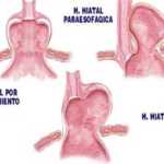 esquema_tipos_hernias_hiato
