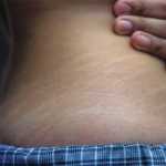 Estrías en las Caderas