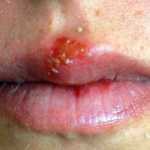 herpes de zoster