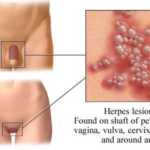 herpes genital