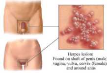 Herpes genital, causas, síntomas y tratamiento