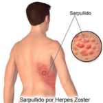 Herpes Zoster