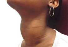 Qué es el hipertiroidismo y el bocio