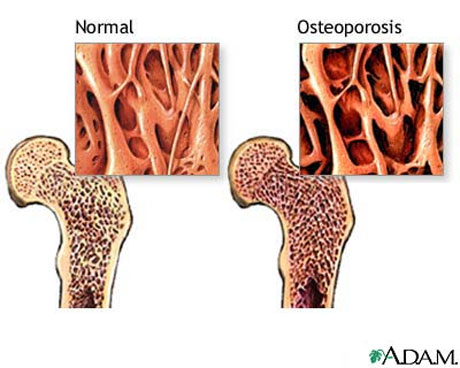 examen de la osteoporosis