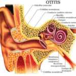 otitis