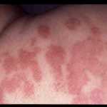 pitiriasis versicolor