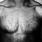 Pitiriasis Versicolor