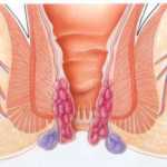 Prevenir las Hemorroides