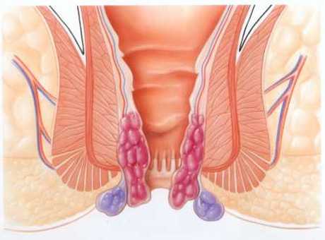 Prevenir las Hemorroides