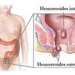 Problemas de Hemorroides
