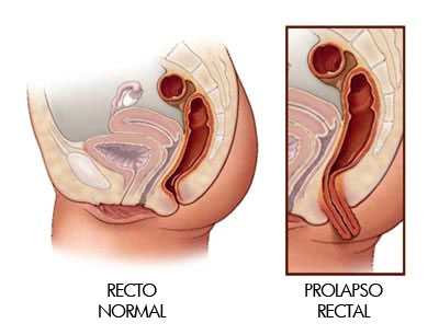 prolapso_rectal1