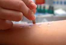 Descubrimiento y tratamiento de la rinitis alérgica