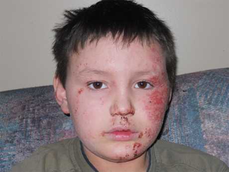 Aspectos del síndrome de job