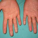 Síndrome de Shock Toxico