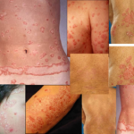 tipos de psoriasis