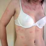 urticaria