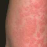 Urticaria Crónica