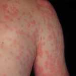 Urticaria Crónica
