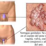 verugas